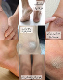 کرم ترک پا
